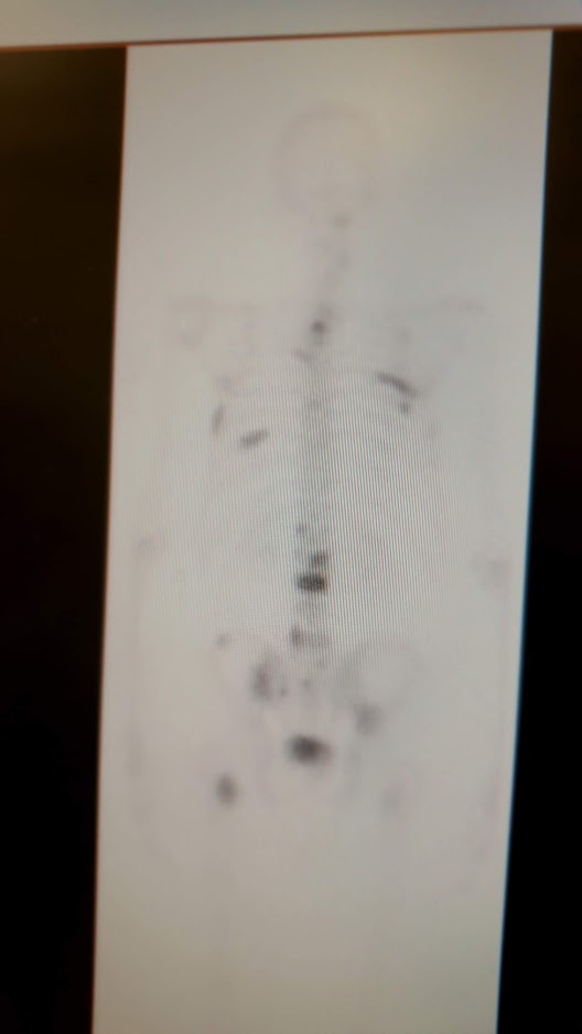 bone scan 4th jan 2019